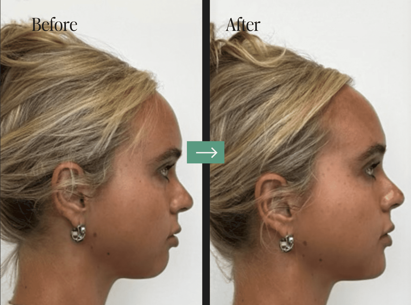 Liposuction Before and After Pictures Charleston, SC